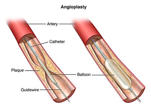 Angioplasty and Stenting